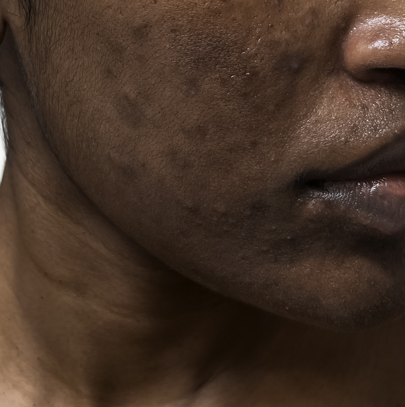 post inflammatory hyperpigmentation on dark skin